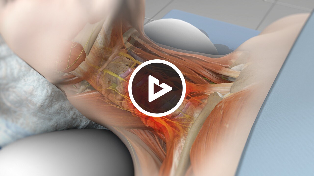 Anterior Cervical Discectomy and Fusion (ACDF) - Neck, Spine & Back ...