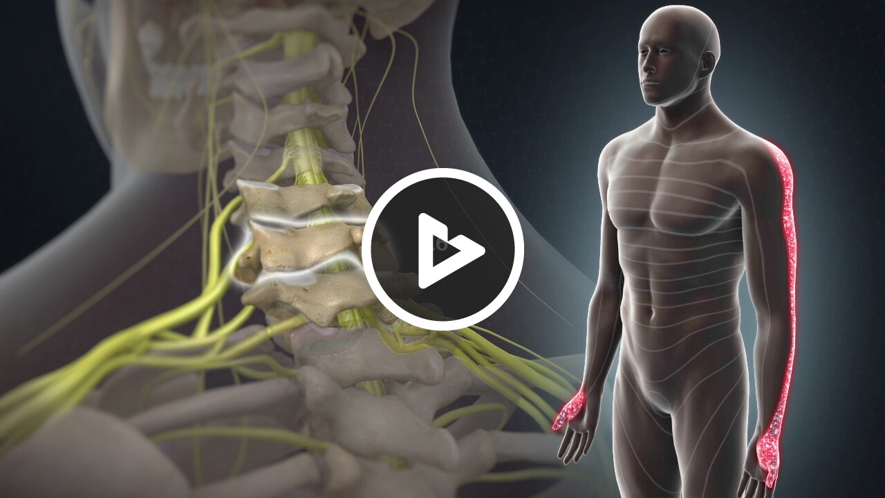 Cervical Radiculopathy Neck, Spine & Back The Orthopaedic Clinic Orthopedic Surgeons