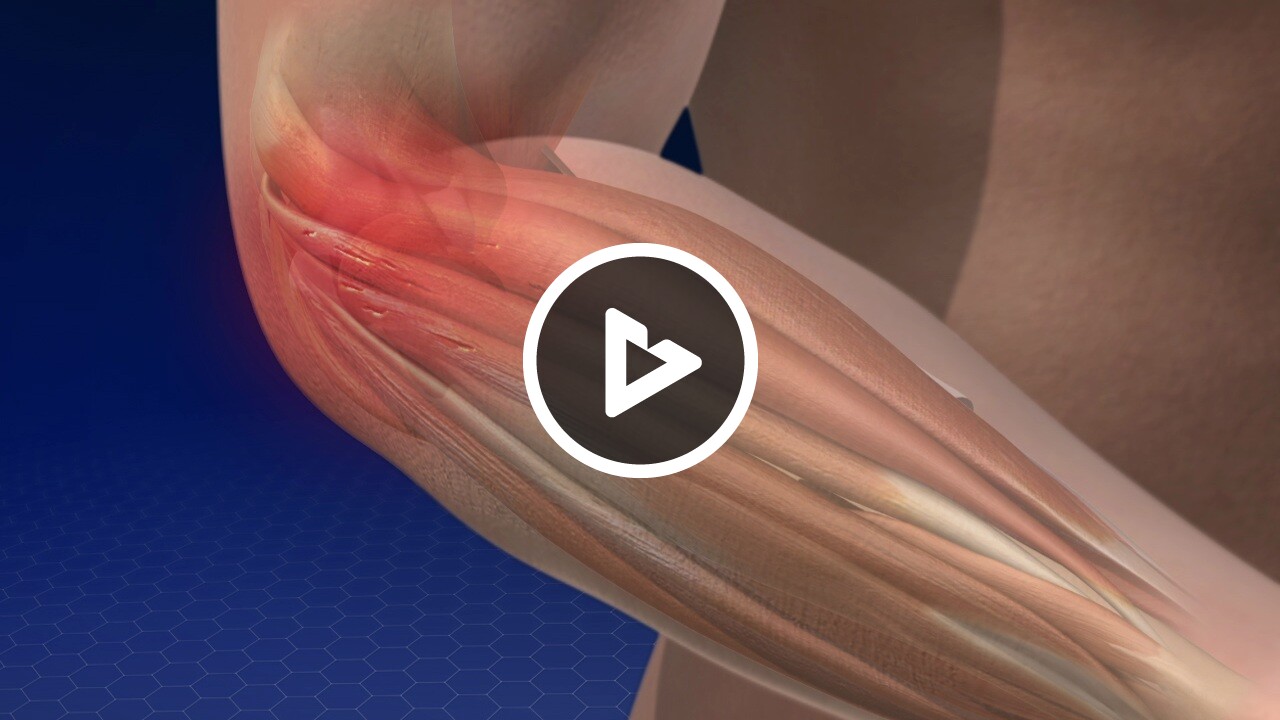Lateral Epicondylitis (Tennis Elbow) Hand, Wrist & Elbow The Orthopaedic Clinic Orthopedic